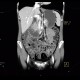 Aortomesenteric compression, SMA syndrome, superior mesenteric artery: CT - Computed tomography